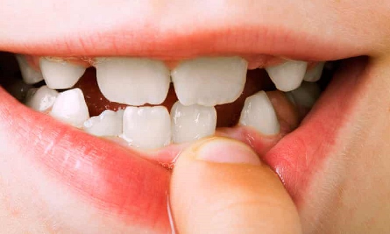 牙周炎的五步治療的方法