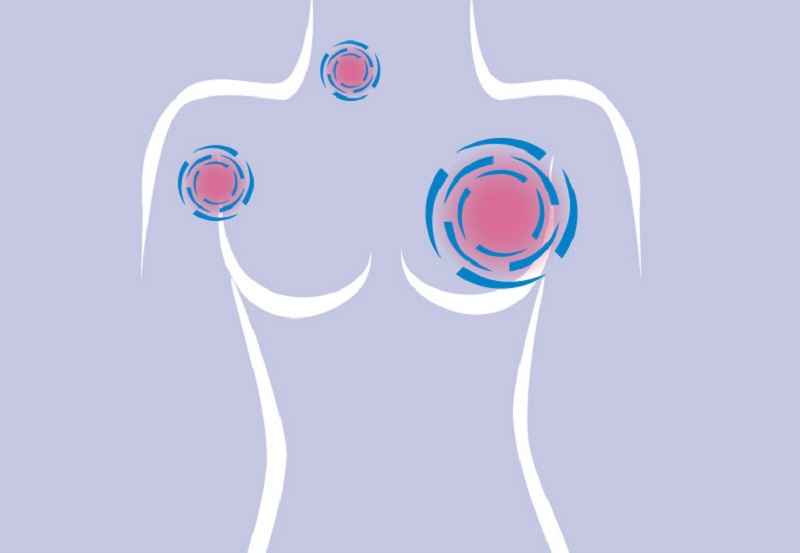 乳腺癌初期的4大資料信號，如果有這類病症，一定不可以忽略